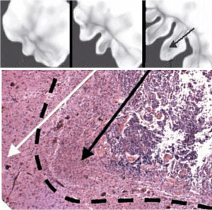 The virtual and the real: Computer-generated depictions of a growing brain tumor show growth at six, eight and 12 months (top, left to right), with development of infiltrative cell front (arrow) at 12 months. Tissue slide (bottom) shows tumor finger (black arrow) advancing in substrate gradient (white arrow). The virtual and the real: Computer-generated depictions of a growing brain tumor show growth at six, eight and 12 months (top, left to right), with development of infiltrative cell front (arrow) at 12 months. Tissue slide (bottom) shows tumor finger (black arrow) advancing in substrate gradient (white arrow).