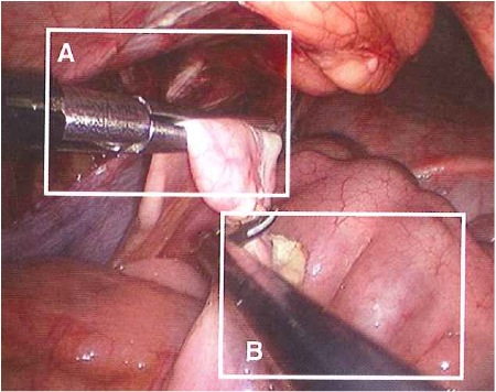 Different parts of the whole: A single laparoscope delivers an image that is large enough to allow each surgeon a highly detailed separate view optimized for the surgical task. Different parts of the whole: A single laparoscope delivers an image that is large enough to allow each surgeon a highly detailed separate view optimized for the surgical task.