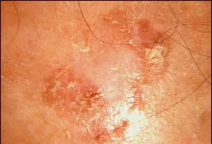 Actinic keratoses: The study provided up to six years of follow-up to quantify the risk of progression of actinic keratoses to cancer. Actinic keratoses: The study provided up to six years of follow-up to quantify the risk of progression of actinic keratoses to cancer.